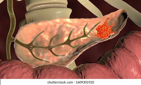 Pancreatic Cancer, Malignant Tumor Of Pancreas, 3D Illustration