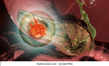 Pancreatic Cancer, Malignant Tumor Of Pancreas, 3D Illustration