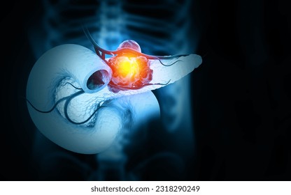 Pancreatic cancer is cancer that forms in the cells of the pancreas. 3d illustration - Powered by Shutterstock