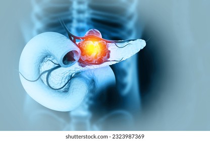 Pancreatic cancer is cancer that forms in the cells of the pancreas. 3d illustration - Powered by Shutterstock