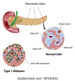 Pancreatic islet normal and that of type 1 diabetes