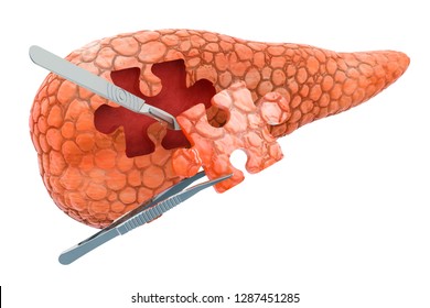 Pancreatic Surgery Concept, 3D Rendering Isolated On White Background