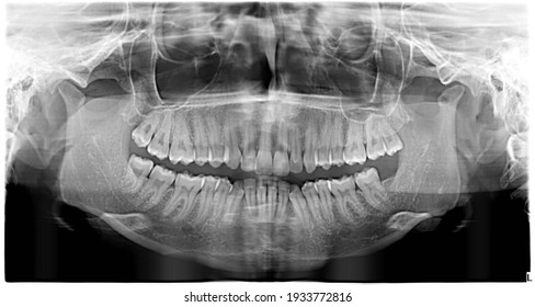 Panoramic x-ray of teeth. With wisdom teeth. Malocclusion. 