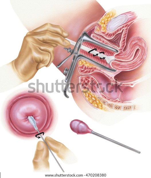 Papanicolaou (Pap) smear. Shown are a cervical\
scrape smear (top), a cervical swab smear (bottom left), and an\
endocervical aspirator (bottom right).\
