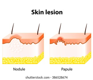 Papule And Nodule. Skin Lesion.