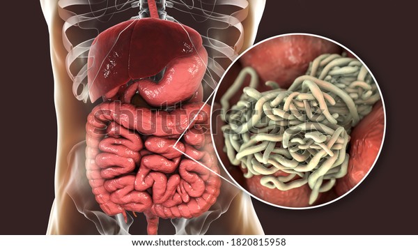 Parasitic worms in human intestine, 3D\
illustration. Ascaris lumbricoides and other round\
worms