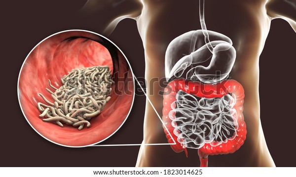 Parasitic worms in\
human large intestine, 3D illustration. Enterobius vermicularis and\
other round\
worms