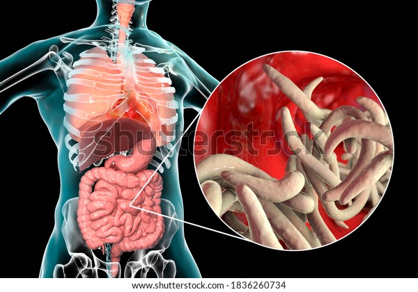 Parasitic worms in\
human small intestine, 3D illustration. Ascaris lumbricoides and\
other round\
worms