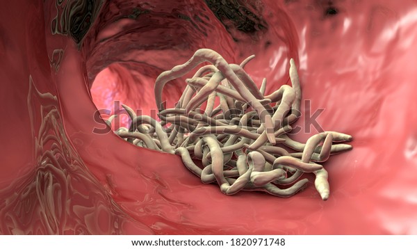 Parasitic worms in the\
lumen of intestine, 3D illustration. Ascaris lumbricoides and other\
round worms