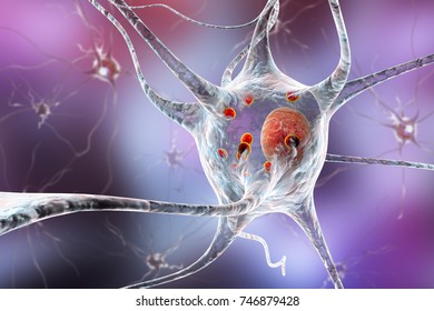 120 Lewy Body Dementia Images, Stock Photos & Vectors | Shutterstock