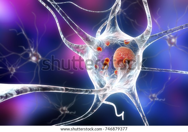 Parkinson\'s disease. 3D illustration showing\
neurons containing Lewy bodies small red spheres which are deposits\
of proteins accumulated in brain cells that cause their progressive\
degeneration