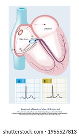 Part Short Pr Interval Ecg Enhanced Stock Illustration 1955527813 ...