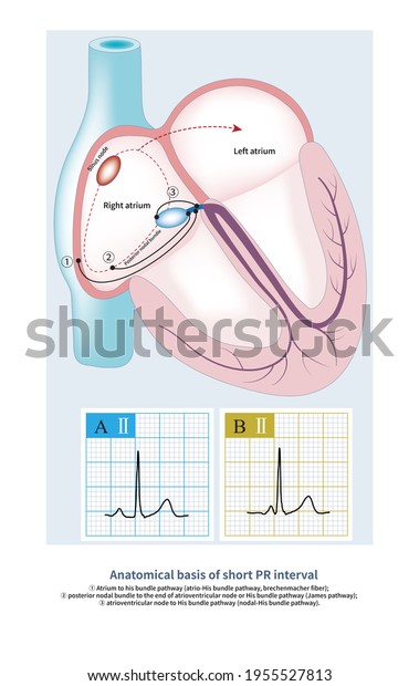 Part Short Pr Interval Ecg Enhanced Stock Illustration 1955527813 ...