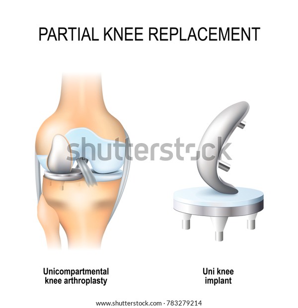Partial Knee Replacement >> Partial Knee Replacement Unicompartmental Knee Arthroplasty Partial Knee Replacement >> Partial Knee Replacement Unicompartmental Knee Arthroplasty