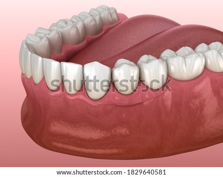 Partial removable immediate-denture type Butterfly. Replacement of one missing tooth 3D illustration