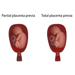 Short cervix in pregnancy