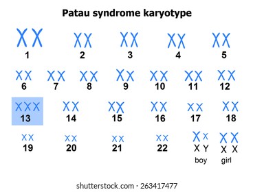 Patau Syndrome Karyotype