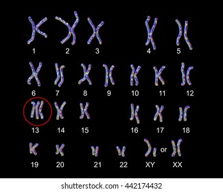 Patau-syndrome Karyotype, Labeled. Trisomy 13. 3D Illustration