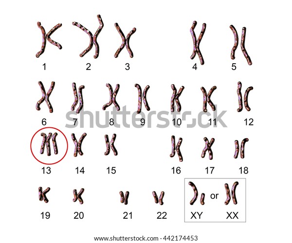 Patausyndrome Karyotype Labeled Trisomy 13 3d Stock Illustration ...