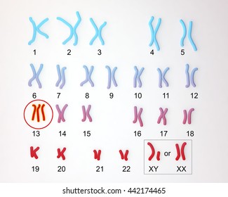 Patau-syndrome Karyotype, Male Or Female, Labeled. Trisomy 13. 3D Illustration