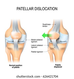 Patellar dislocation. Normal position of kneecap and Patella displaced. Anatomy of the Knee