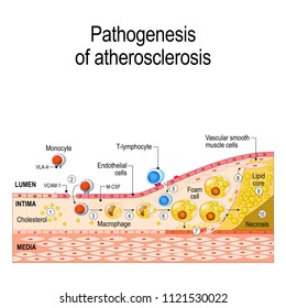 Pathogenesis of atherosclerosis. Cholesterol plaque, and thrombus formation. Cells structure (vascular smooth muscle cells, T-lymphocyte, endothelial cells, monocyte, Foam cell, Macrophage
