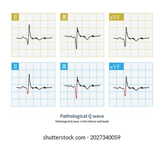 Pathological Q Wave Ecg Index Myocardial Stock Illustration 2027340059 Shutterstock