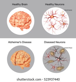 The Patient And The Brain Healthy Brain And Neurons In Comparison.
Alzheimer's Disease. Amyloid Plaque.