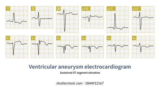 St elevation ecg Images, Stock Photos & Vectors | Shutterstock