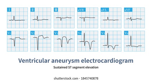 St elevation myocardial infarction Images, Stock Photos & Vectors ...