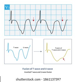 53 Inverted T Wave Images, Stock Photos & Vectors | Shutterstock