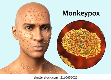 Patient with monkeypox and close-up view of monkeypox virus, 3D illustration. Monkeypox is a zoonotic virus from Poxviridae family, causes a pox-like disease