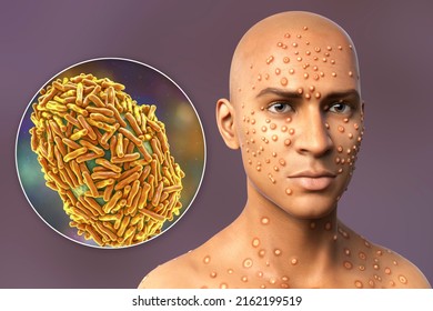 Patient with monkeypox and close-up view of monkeypox virus, 3D illustration. Monkeypox is a zoonotic virus from Poxviridae family, causes a pox-like disease
