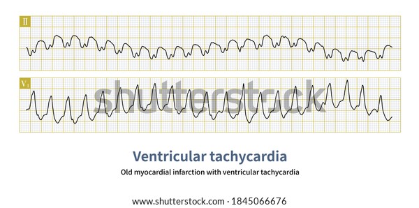 Patient Old Myocardial Infarction Developed Paroxysmal Stock ...