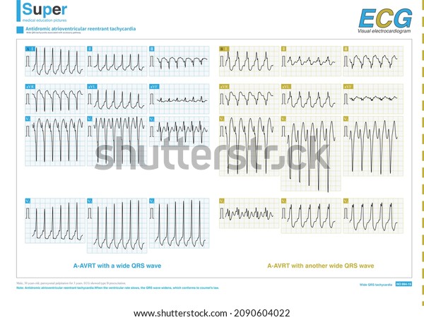 Patients Basic Ecg Showed Type B Stock Illustration 2090604022 ...