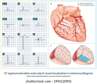 Patients St Segment Elevation Myocardial Infarction Stock Illustration ...