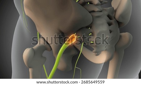 Pelvis with Sciatic Nerve Tumor 3d illustration