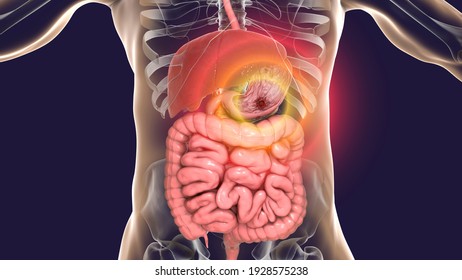 Peptic Ulcer, 3D Illustration Showing An Ulcer On The Stomach Surface