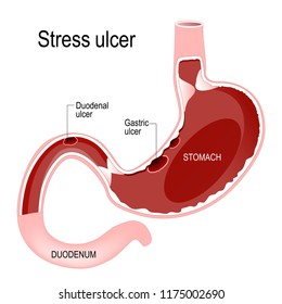 Peptic Ulcer Disease. Gastric And Duodenal Ulcer. Stress Ulcer Is A Mucosal Defect. This Ulcers Can Be Located Anywhere Within The Stomach And Proximal Duodenum. Human Anatomy