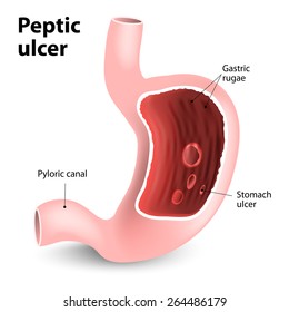 Peptic Ulcer Disease (PUD). Illustration Of Human Stomach Anatomy