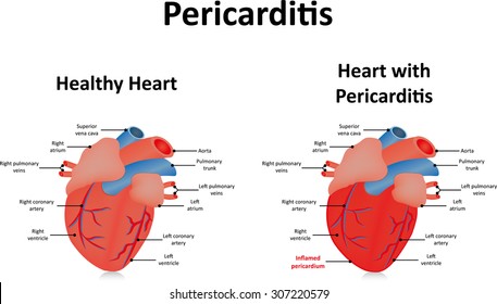 Pericarditis