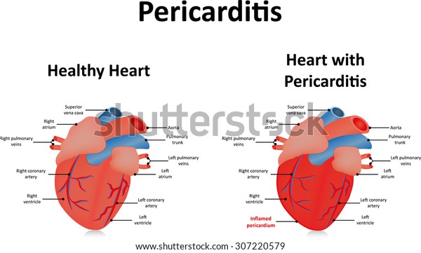 Pericarditis Stock Illustration 307220579 | Shutterstock