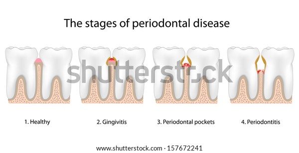 Periodontal Disease Stock Illustration 157672241 | Shutterstock