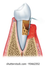 periodontal disease stages,