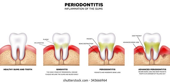 Periodontitis and inflammation of the gums, detailed illustration