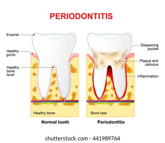 95 Gingival sulcus Images, Stock Photos & Vectors | Shutterstock