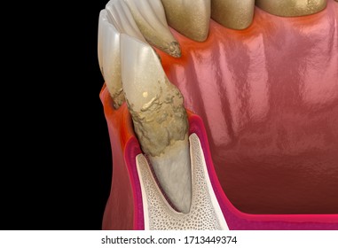 Periodontitis stage 3, gum recession, tartar. Medically accurate 3D illustration