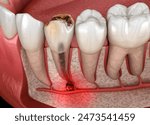 Periostitis tooth - Lump on Gum Above Tooth. Dental 3D illustration