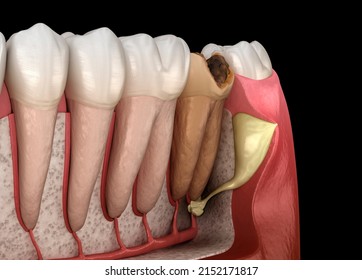 Periostitis Tooth - Lump On Gum Above Tooth. Dental 3D Illustration