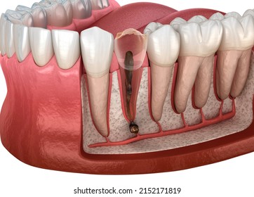 Periostitis Tooth - Lump On Gum Above Tooth. Dental 3D Illustration